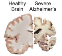 a comparison between healthy brain and Alzheimer's brain in which the Alzheimer's brain shows significantly more deterioration and shrinkage